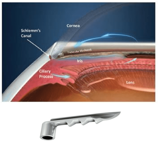 glaucoma fraser valley cataract laser