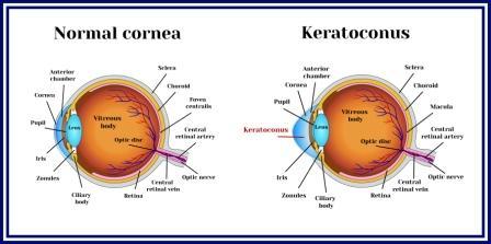 Corneal Collagen Cross-Linking