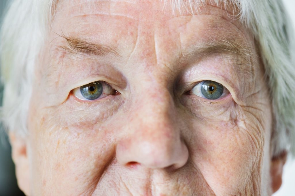 elderly woman candidate Oculoplastic Surgery