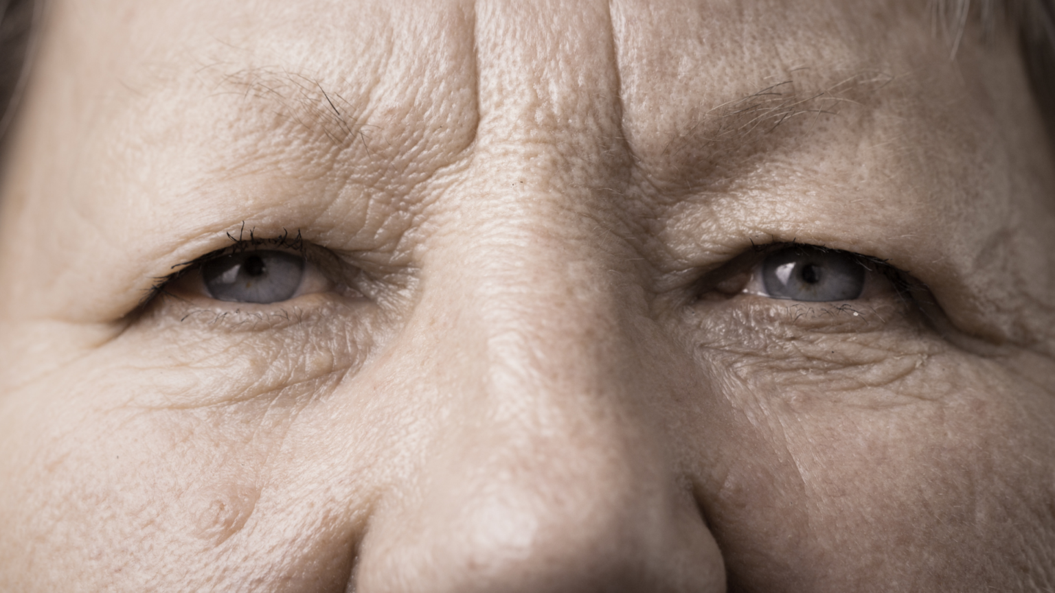 Droopy Upper Eyelids And Treatment Options Fraser Valley Cataract Laser