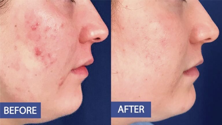 Acne treatment before and after: inflamed acne across the cheek and jaw calmed, before on the left and after on the right