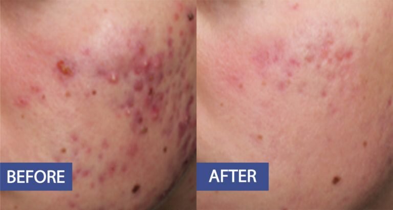Acne treatment before and after: raised acne lesions and scarring on the cheek reduced, before on the left and after on the right