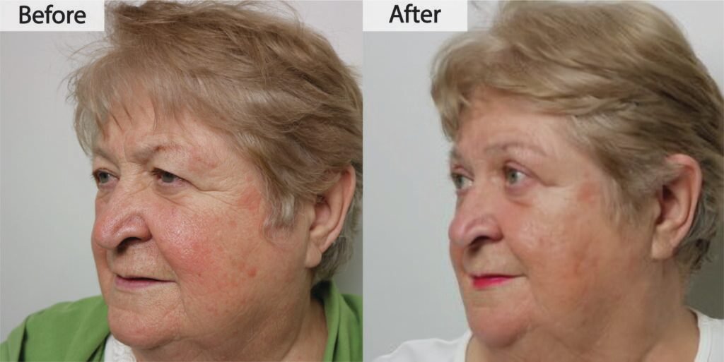 Blepharoplasty before and after, three quarter view: hooded upper eyelids lifted, before on the left and after on the right
