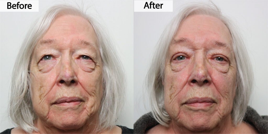 Blepharoplasty before and after, front view: heavy upper eyelid skin removed and the eyes opened up, before on the left and after on the right