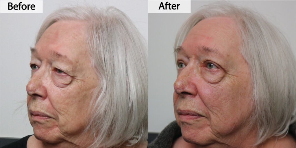 Blepharoplasty before and after, three quarter view: heavy upper eyelid skin removed, before on the left and after on the right