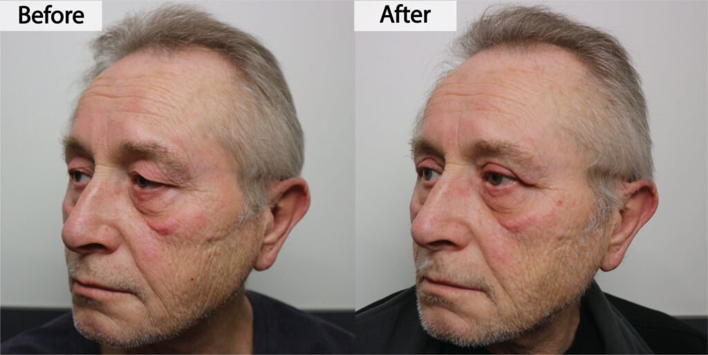 Blepharoplasty before and after, three quarter view: drooping upper eyelid skin lifted off the lashes, before on the left and after on the right