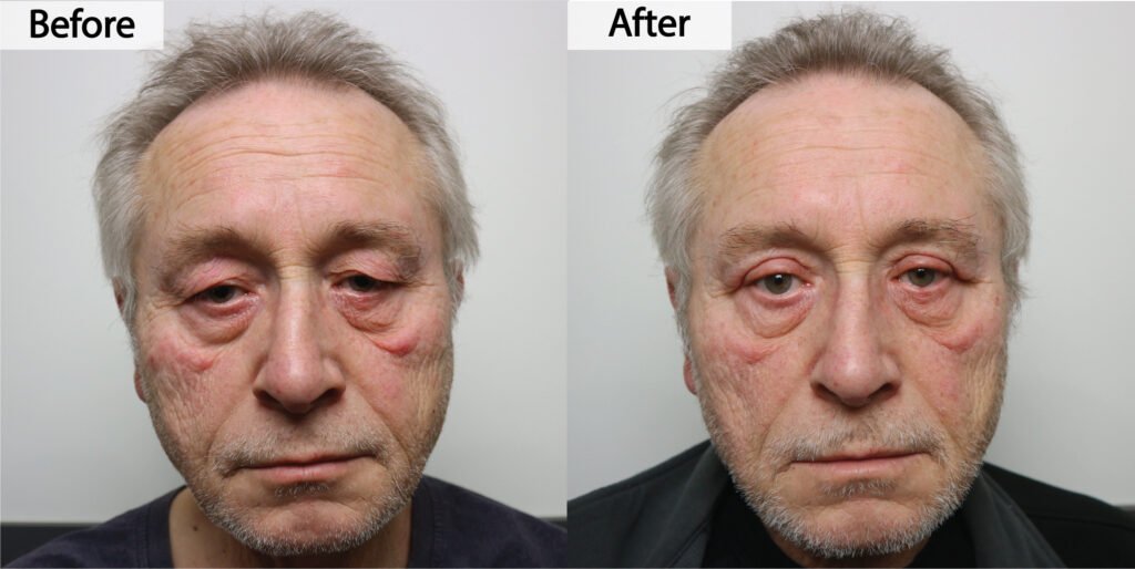 Blepharoplasty before and after, front view: drooping upper eyelid skin lifted and the field of view opened, before on the left and after on the right