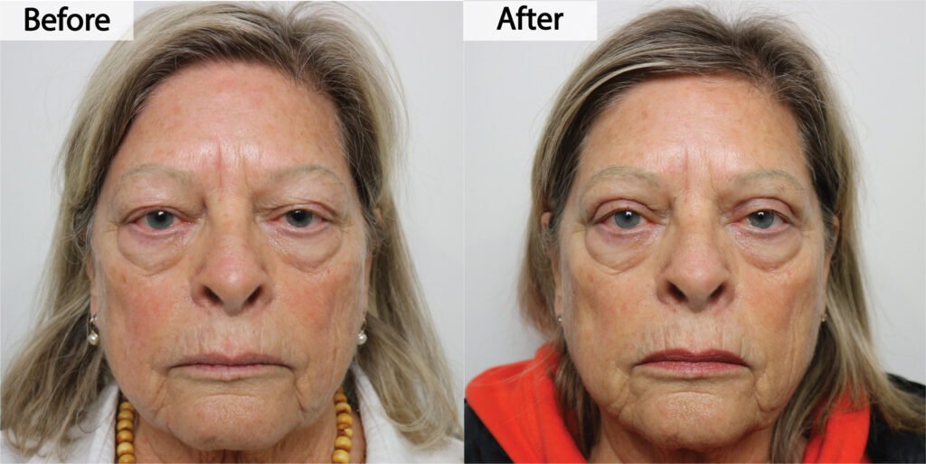 Blepharoplasty before and after, front view: sagging upper eyelid skin removed, before on the left and after on the right