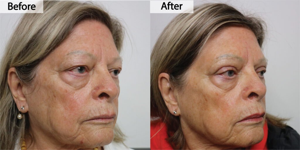Blepharoplasty before and after, three quarter view: sagging upper eyelid skin removed, before on the left and after on the right