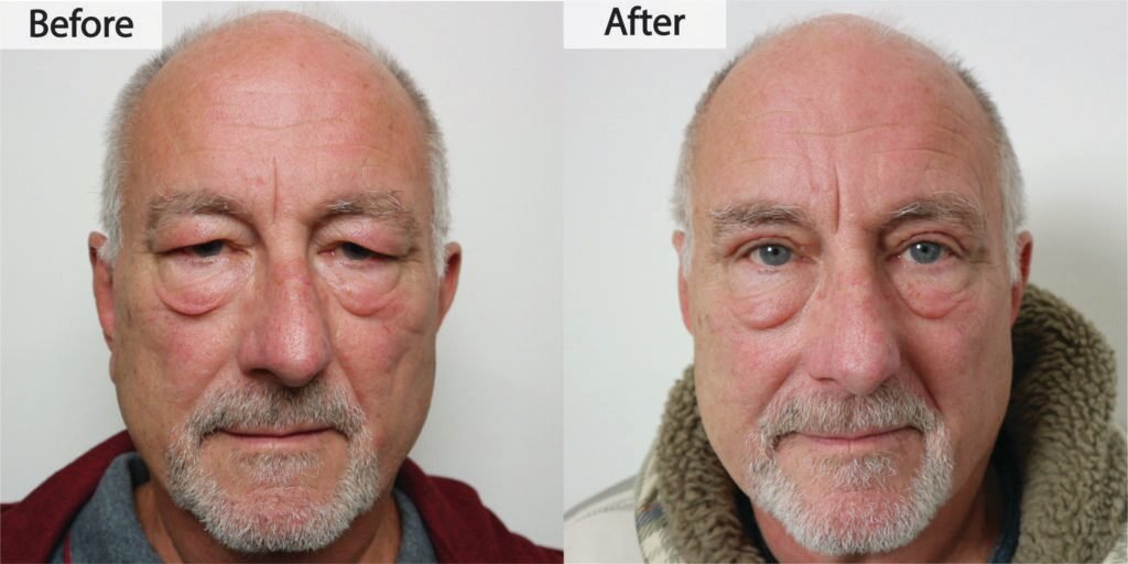 Blepharoplasty before and after, front view: upper eyelid skin that rested on the lashes lifted clear, before on the left and after on the right