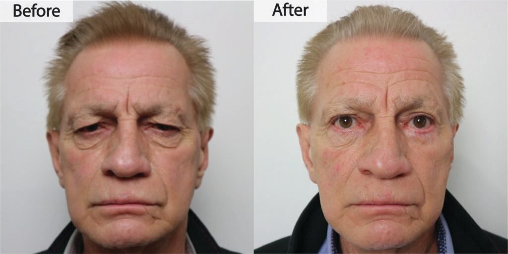 Blepharoplasty before and after, front view: heavy upper lids raised and the eyes made more symmetrical, before on the left and after on the right