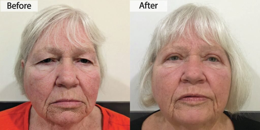 Blepharoplasty before and after, front view: overhanging upper eyelid skin removed, before on the left and after on the right