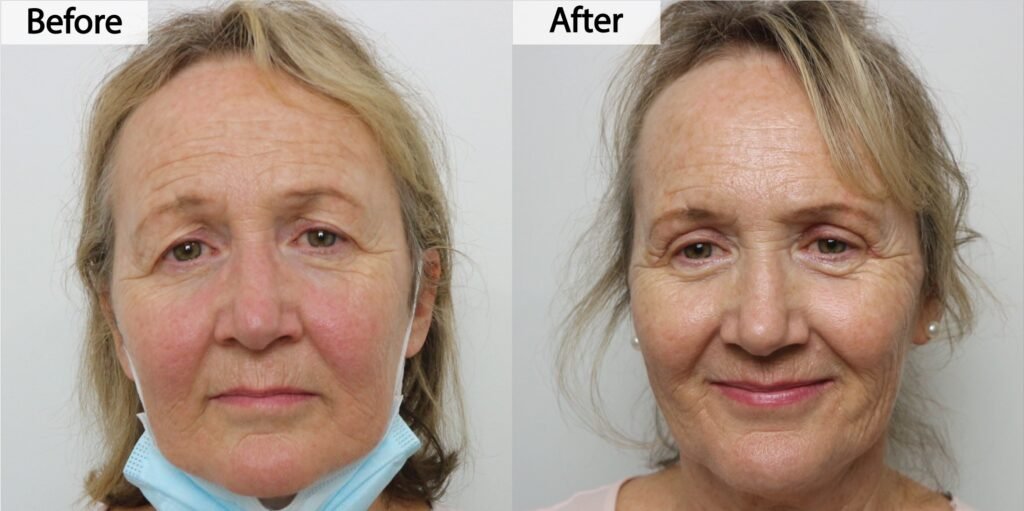 Blepharoplasty before and after, front view: upper eyelid skin removed and the brow area opened up, before on the left and after on the right