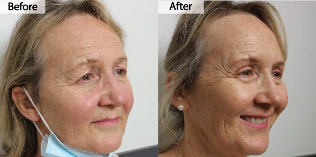 Blepharoplasty before and after, three quarter view: upper eyelid skin removed, before on the left and after on the right