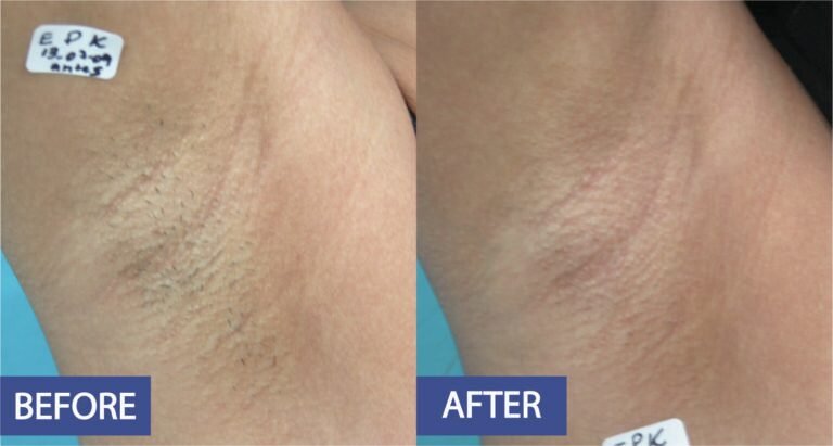 Laser hair removal before and after on the underarm: hair growth cleared, before on the left and after on the right