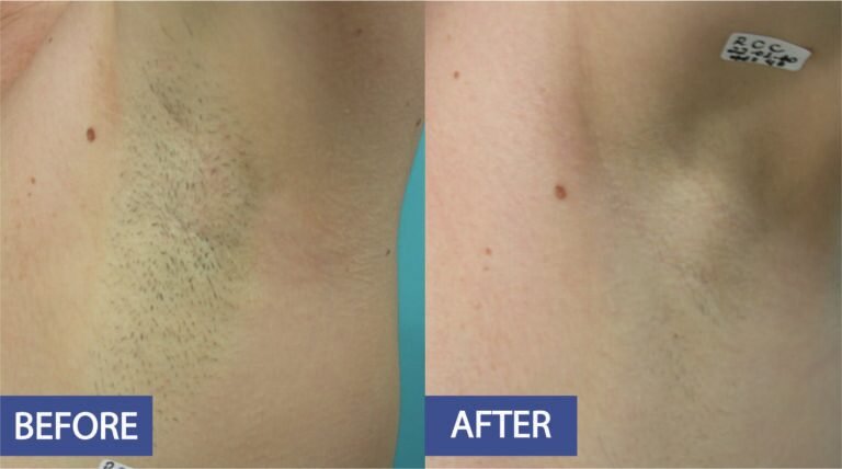 Laser hair removal before and after on the underarm: thick, dark hair growth cleared, before on the left and after on the right
