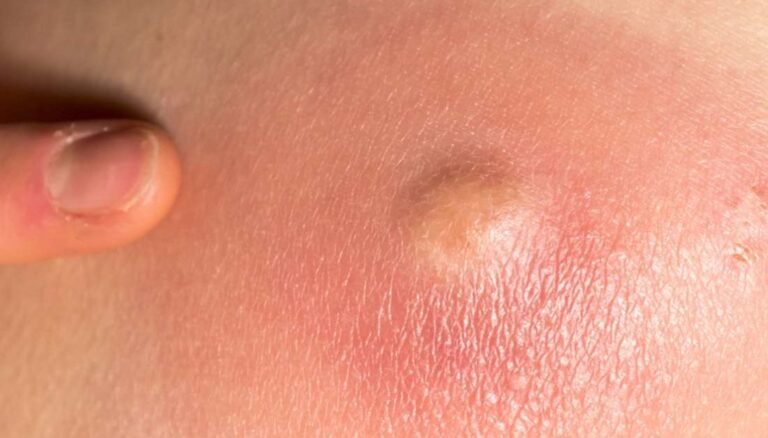 Close-up of a cyst raised under the surface of the skin, examined with a fingertip