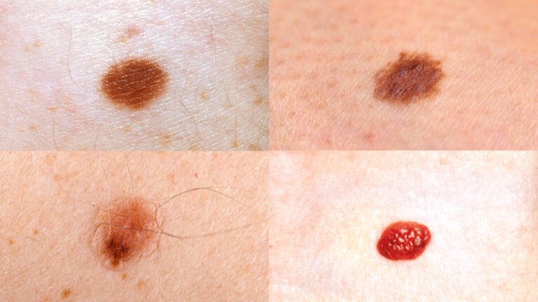 Four close-up examples of moles and nevi of differing size, colour and shape