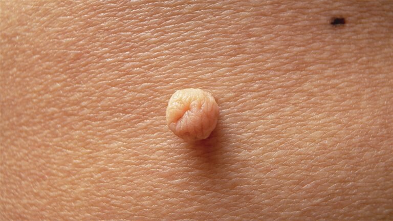 Close-up of a raised skin tag on the skin, one of the common abnormalities that can be removed