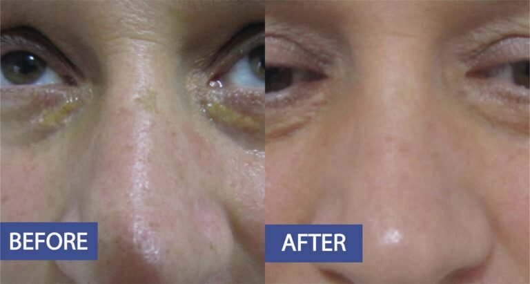 Lower lid resurfacing before and after: raised yellow deposits under both eyes cleared and the skin smoothed, before on the left and after on the right