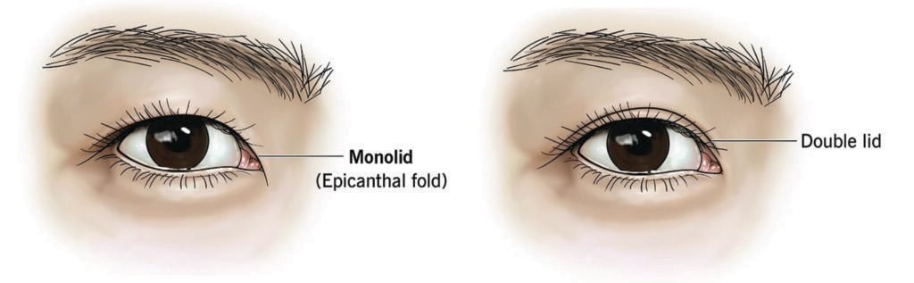 Illustration comparing a monolid, where an epicanthal fold covers the inner corner and there is no crease, with a double lid that has a defined eyelid crease