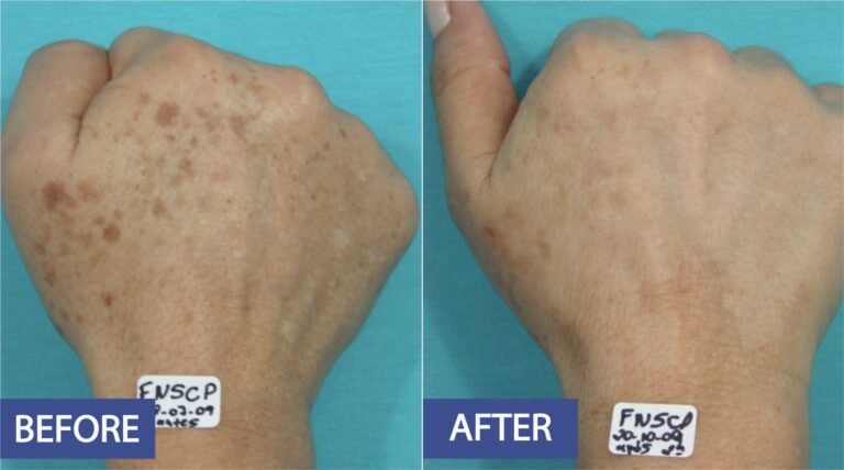 Pigmentation correction before and after: sun spots on the back of the hand lightened, before on the left and after on the right