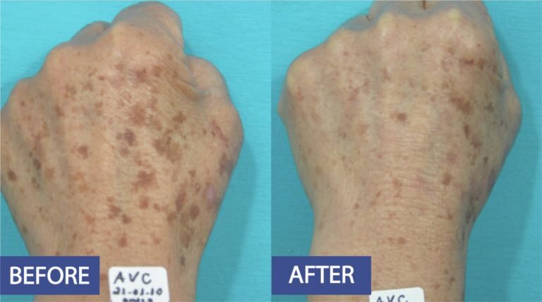 Pigmentation correction before and after: dense sun spots across the back of the hand cleared, before on the left and after on the right
