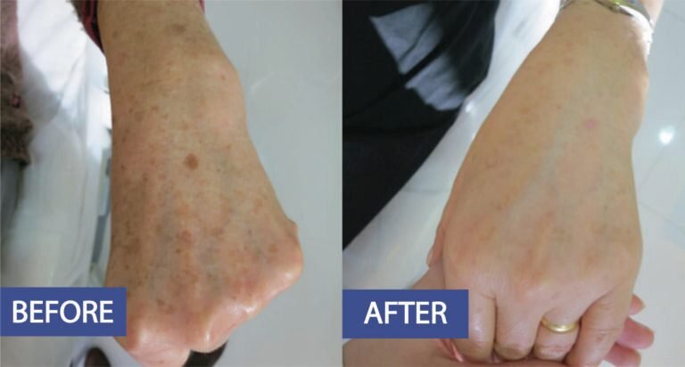 Pigmentation correction before and after: age spots along the forearm and wrist faded, before on the left and after on the right