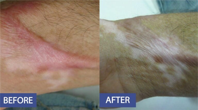 Scar treatment before and after: a raised, reddened scar on the forearm flattened and evened in colour, before on the left and after on the right