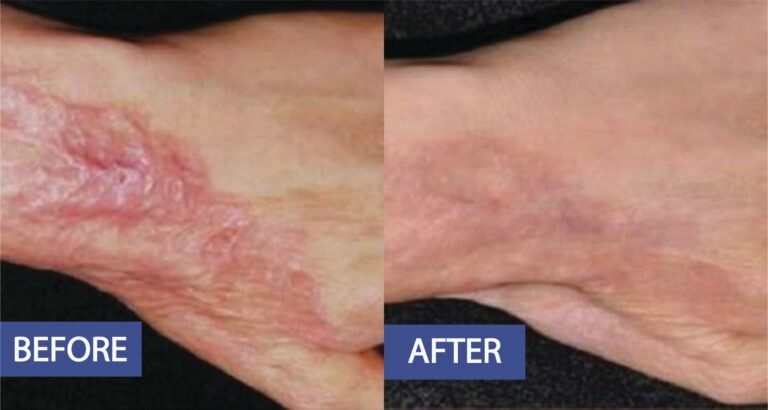 Scar treatment before and after: a raised scar across the wrist smoothed, before on the left and after on the right