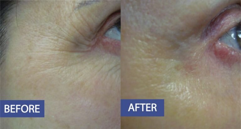 Skin toning and tightening before and after: fine lines beside the outer corner of the eye softened, before on the left and after on the right