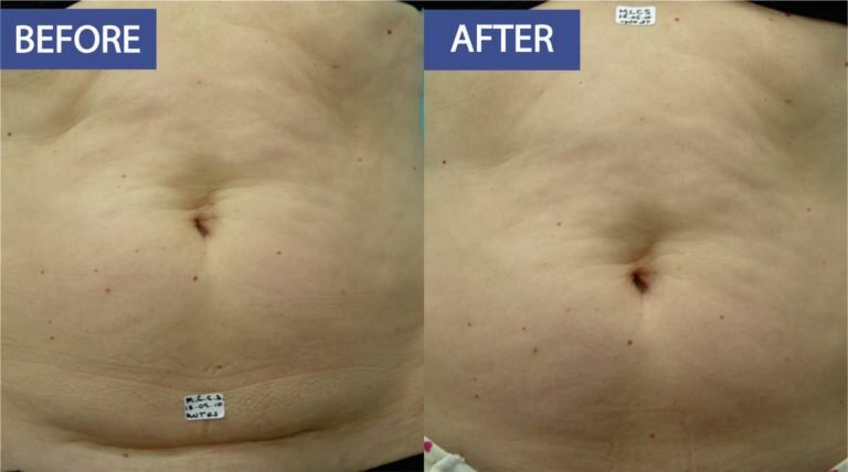Skin toning and tightening before and after: loose skin and texture across the abdomen firmed, before on the left and after on the right