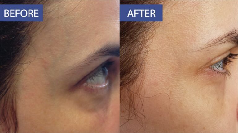 Thermal peeling before and after: pigmentation across the temple and forehead lightened, before on the left and after on the right