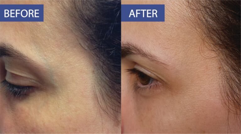Thermal peeling before and after: patchy pigmentation at the brow and temple evened out, before on the left and after on the right
