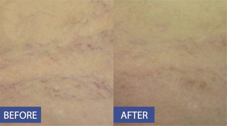 Thermal peeling before and after: fine lines and uneven skin texture softened, before on the left and after on the right