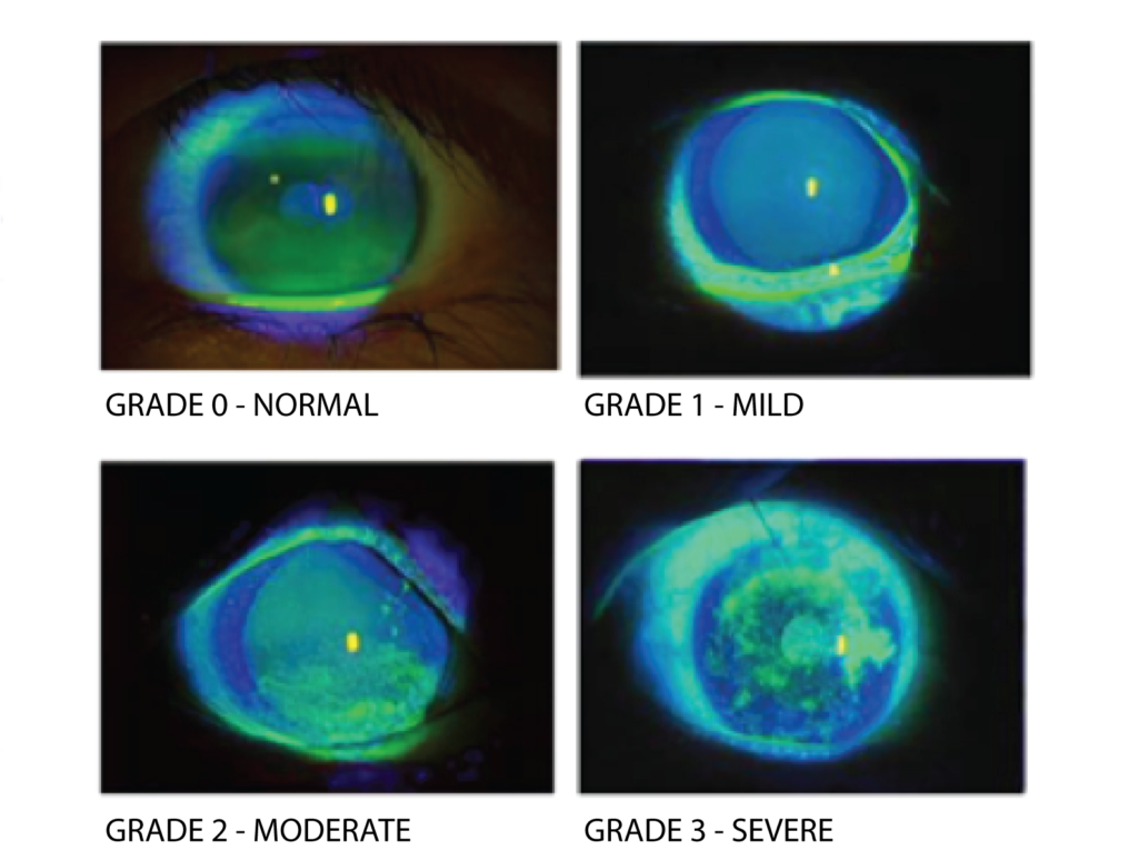Corneal staining photographs showing various degrees of dryness on the epithelium