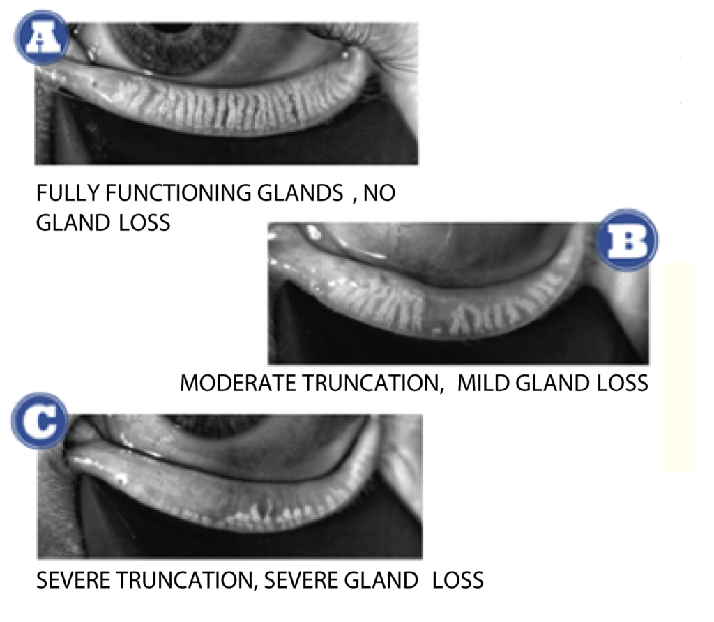 Lipiscan meibomian gland imaging showing gland condition and atrophy
