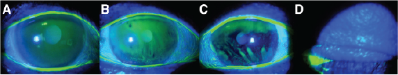 Tear break up time test images, with image B showing a dry spot in the tear film