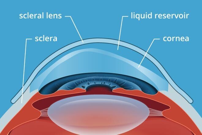 Scleral contact lenses that vault over the cornea and rest on the sclera