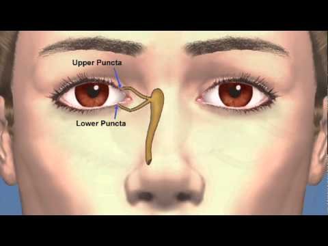Video explaining how punctal plugs reduce tear drainage