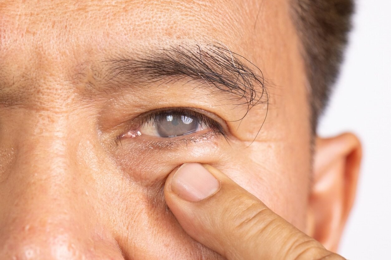 Cataract Surgery
